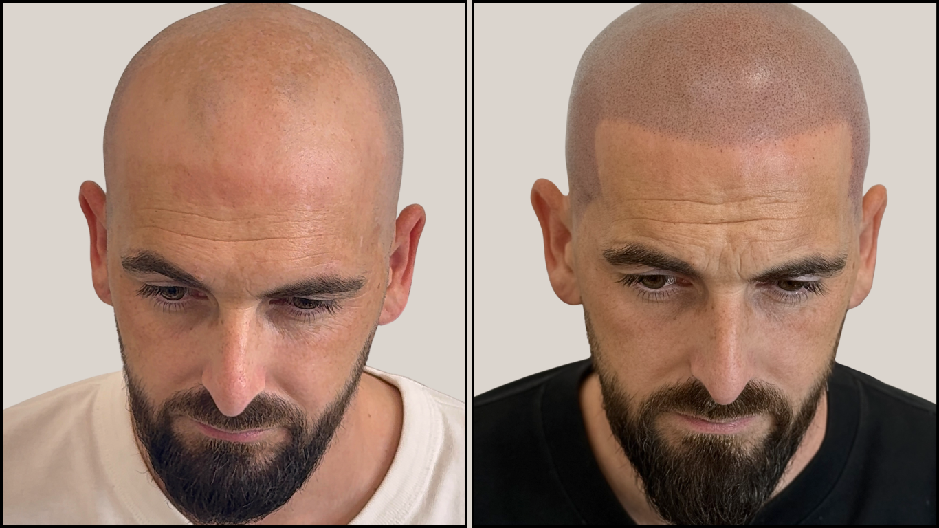 Effet rasé — Homme