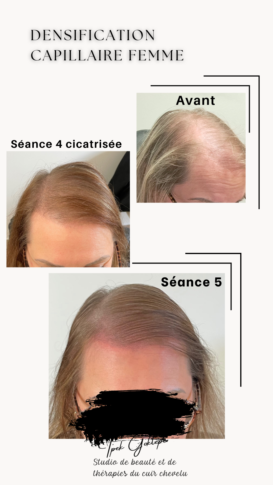 Beige Minimalist Skincare Before and After Instagram Post (1080 x 1350 px) (Votre story)